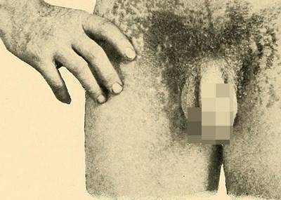เริมที่อวัยวะเพศ (Genital Herpes Simplex Virus Infection)