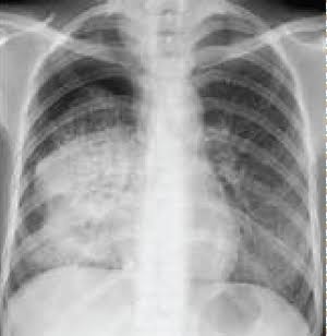 วัณโรคปอด (pulmonary TB)